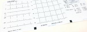 vzor EKG k posouzení internistou.JPG